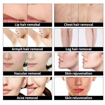 IPL OPT Laser Hair Removal Machine