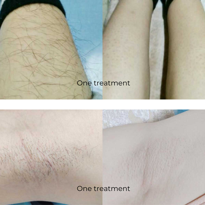 Torno Elite Plus - Diode Laser Hair Removal Machine (4 Wavelengths)
